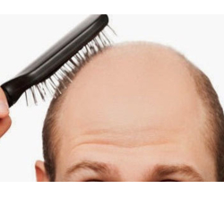 Алопеция (облысение)