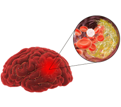 Атеросклероз