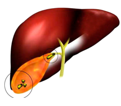Желчнокаменная болезнь (ЖКБ)