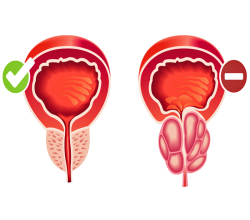 Заболевания предстательной железы