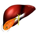 Желчнокаменная болезнь (ЖКБ)