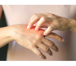 Дерматологические заболевания