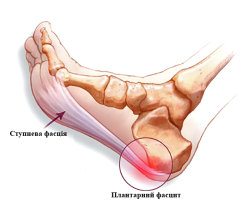 Пяточные шпоры