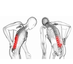 Протрузии межпозвоночного диска