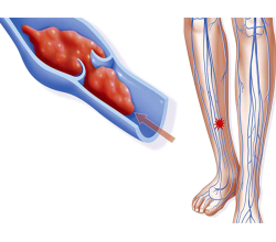 Тромбофлебит