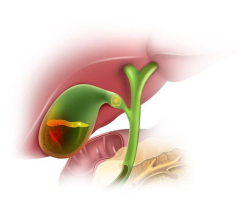 Холецистит