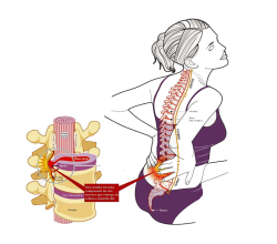 Межпозвоночная грыжа
