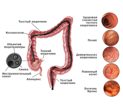 Спаечная болезнь