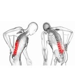 Протрузии межпозвоночного диска