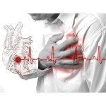 Стенокардия