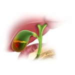 Холецистит