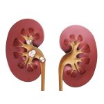 Мочекаменная болезнь