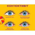 Конъюнктивит