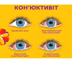 Конъюнктивит